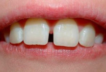 Mặt dán sứ Veneer – Đỉnh cao công nghệ làm răng sứ đều đẹp
