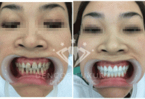 Làm cầu răng giá bao nhiêu cho trường hợp bị mất 2 răng liên tiếp?