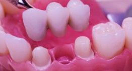 Cầu răng sứ – Giải pháp tái sinh cho các răng đã mất nhanh chóng