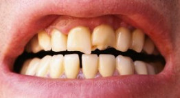 Răng sứ dùng được bao lâu?- Chia sẻ thực tế từ chuyên gia nha khoa