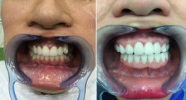 Tất tần tật những thông tin về răng sứ cercon là gì?