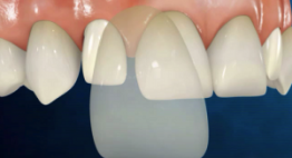 Quy trình làm mặt dán sứ Veneer chính xác cho kết quả thẩm mỹ răng như ý