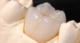 Độ bền của răng sứ Cercon được duy trì trong bao lâu?