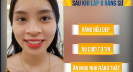 Khắc phục răng khấp khểnh, kém thẩm mỹ bằng công nghệ bọc răng sứ 2in1 hiện đại