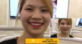 Ngỡ ngàng với sự thay đổi diện mạo sau khi bọc răng sứ
