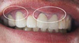 Tháo răng sứ làm lại có đau không? – Những vấn đề đáng để lưu tâm