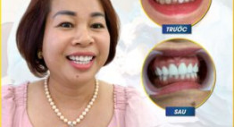 Tạm biệt hàm răng khấp khểnh, xỉn màu, vàng ố… với bọc răng sứ 2in1