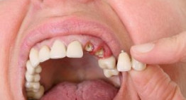 Mất 2 răng có bọc răng sứ được không? – Bất ngờ với tư vấn từ BS