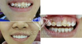 Chỉnh Răng Mọc Lệch hiệu quả bằng phương pháp Bọc Răng Sứ