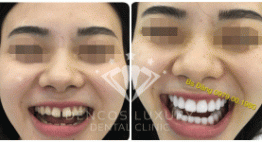 Thẩm mỹ răng cửa xấu, hỏng với phương pháp bọc răng sứ
