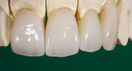 Trồng răng sứ loại nào tốt nhất và duy trì kết quả bền lâu?