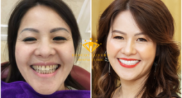 Bọc trọn bộ 20 răng sứ cao cấp chuẩn Đức cho khách hàng kiều bào Đức