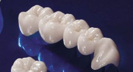Tầm quan trọng của việc bọc răng sứ cercon cần phải biết ngay