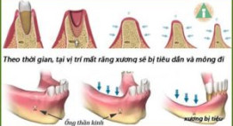 Tiêu xương răng chữa ở đâu tốt, an toàn và uy tín?