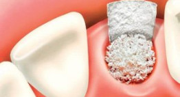 Ghép xương hàm có đau không? – Đi tìm câu trả lời xác thực nhất
