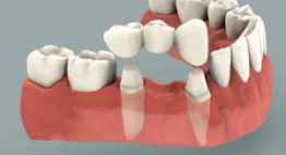 Cầu răng sứ – Lựa chọn thông minh cho hàm răng phục hình
