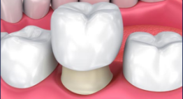 ⌈UPDATE⌉ Bọc răng sứ giá bao nhiêu tiền? – Chi phí cho mọi dòng sứ