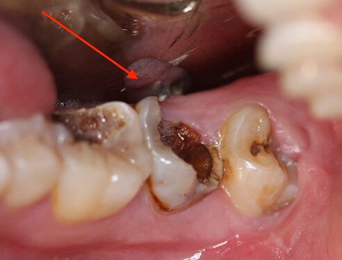bọc răng hàm 1