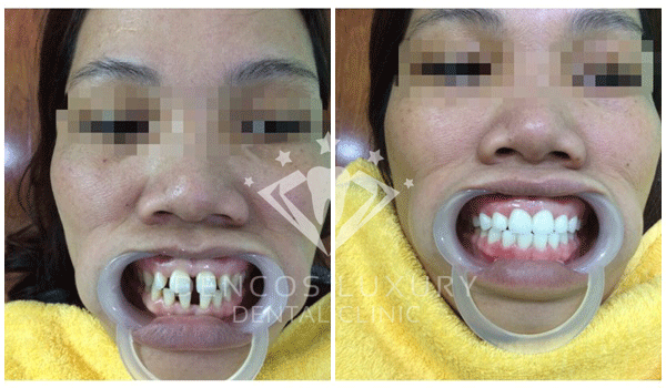 Mặt dán sứ Veneer 8