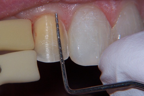 bọc răng sứ có ảnh hưởng đến răng thật không 4