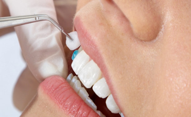 Mặt dán sứ Veneer 5