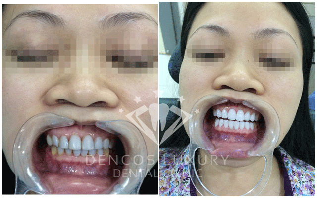 Làm răng đều đẹp