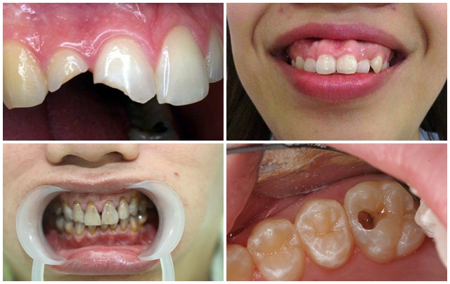 làm răng đều đẹp