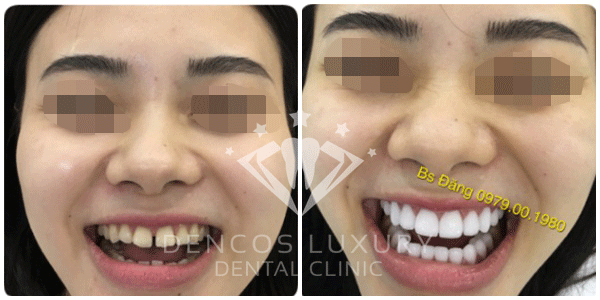 Mặt dán sứ Veneer 3