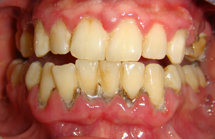 Thay chụp răng sứ 1