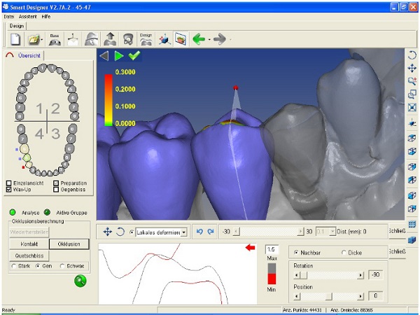Răng sứ Cercon HT được chế tạo tự động hóa bằng phần mềm hiện đại