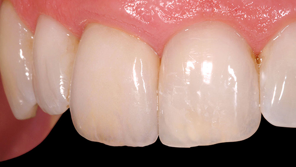 Khách hàng có thể bị lộ tình trạng viền lợi đổi màu sau khi dùng răng sứ Cercon 1 thời gian