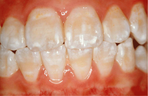 cách khắc phục thiếu sản men răng