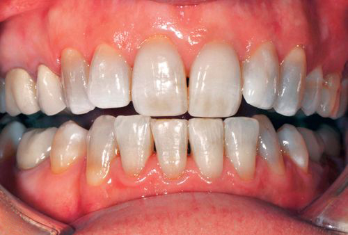 cách khắc phục thiếu sản men răng 3