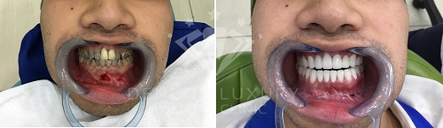 cách khắc phục thiếu sản men răng 5