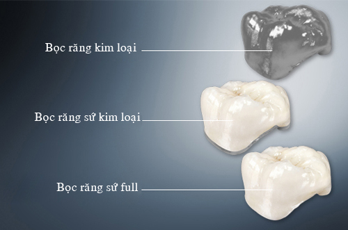 Răng sứ kim loại có tốt không?