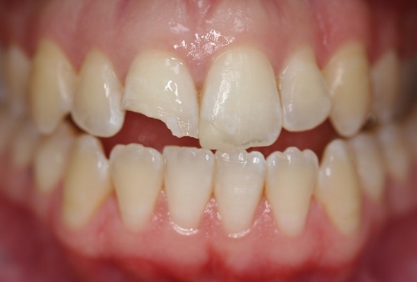 răng sứt mẻ