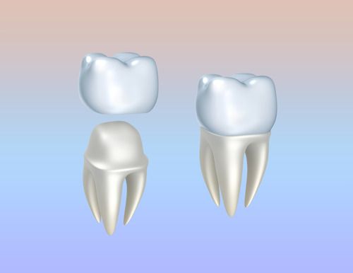 bọc mão răng là gì