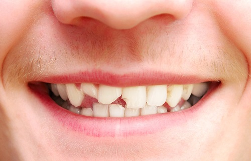 bọc mão răng là gì 2