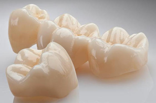 bọc mão răng là gì 3