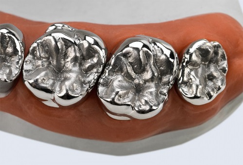 bọc mão răng là gì 4