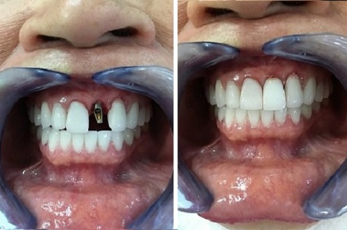 bọc mão răng là gì 6