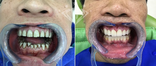 bọc mão răng là gì 8