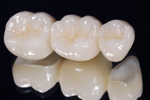 bọc răng sứ alumina 3