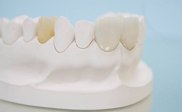 bọc răng sứ cercon