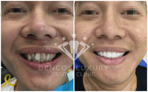 bọc răng sứ cercon 3