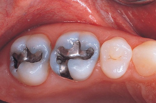 cách trị sâu răng hiệu quả nhất
