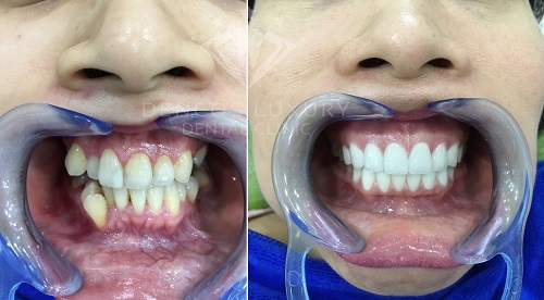 răng sứ cercon zirconia 4