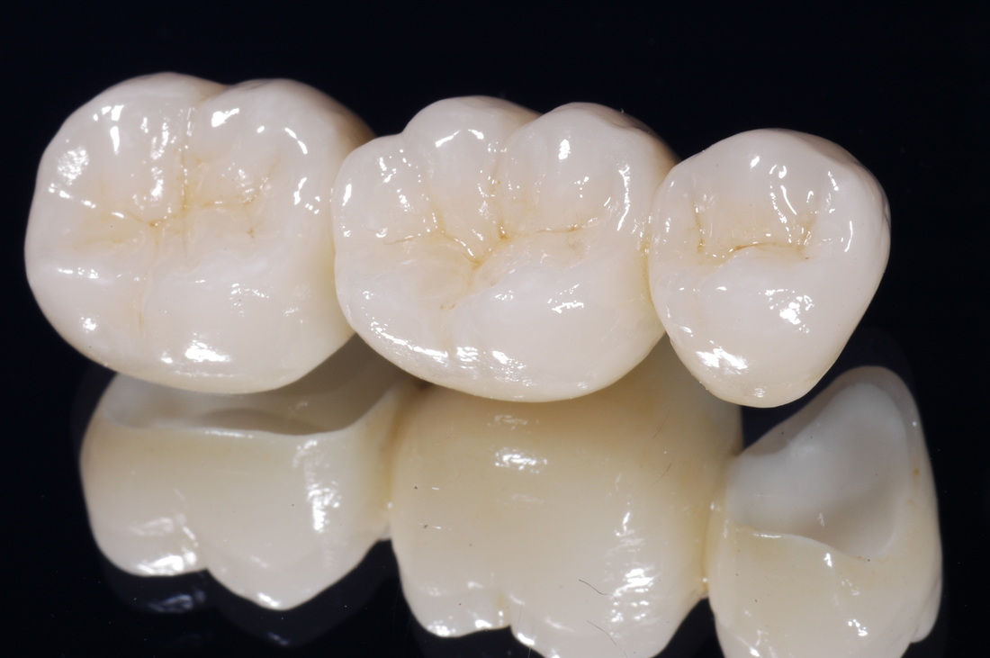 răng sứ cercon là gì