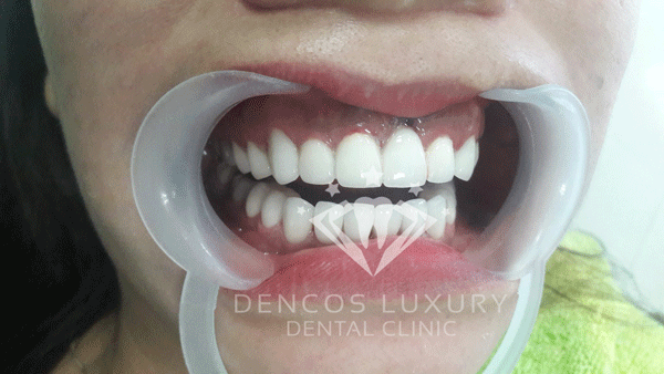 2 giải pháp chỉnh sửa răng cửa to đáng để bạn thử ngay! Chỉnh sửa răng cửa to