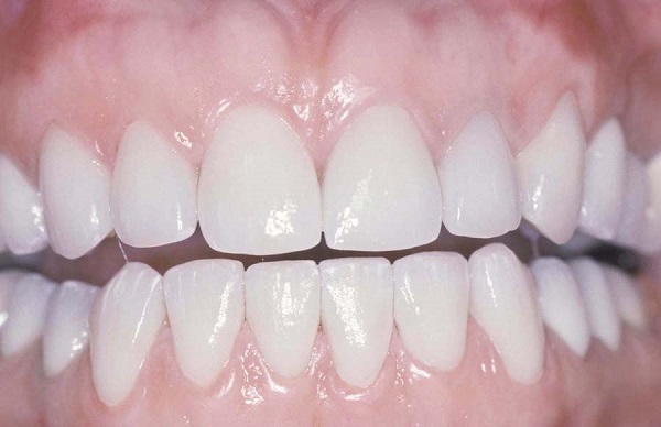 bọc răng sứ không kim loại